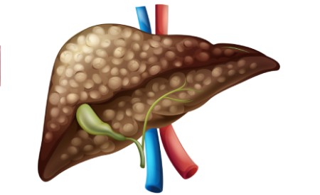 liver-disease