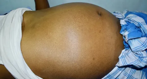 ayurvedic-treatment-of-ascites-in-india