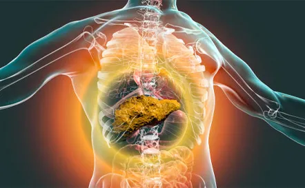 Cirrhosis-of-liver