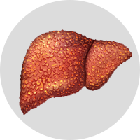 alcohol-induced-liver-ayurvedic-treatment