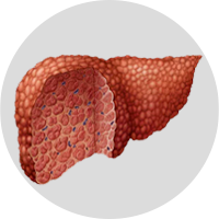 hemochromatosis-ayurvedic-treatment