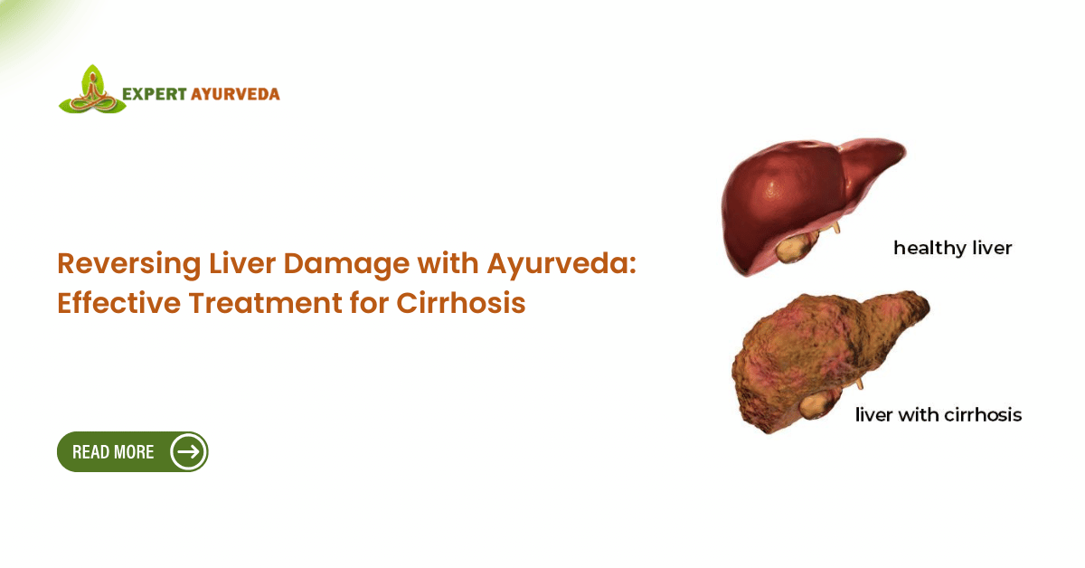 Ayurvedic Treatment for Liver Cirrhosis in India